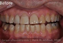 Before Dental Treatment with Sarasota Dentistry