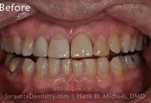 Before Dental Treatment with Sarasota Dentistry