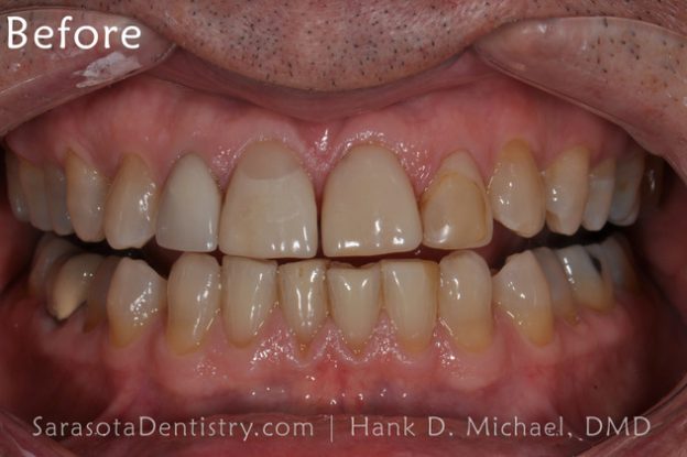 Before Dental Treatment with Sarasota Dentistry