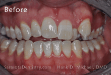 Before Dental Treatment Pic for Sarasota Dentistry