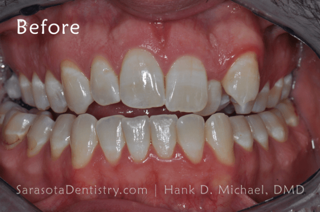 Before Dental Treatment Pic for Sarasota Dentistry