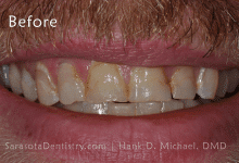Before Pic of Dental Care with Sarasota Dentistry