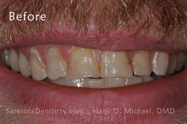 Before Pic of Dental Care with Sarasota Dentistry