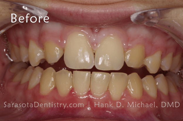 Before Pic of Dental Treatment with Sarasota Dentistry