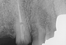 x-ray before dental implants