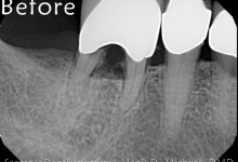 before tooth extraction dental implant and temporary crown placement