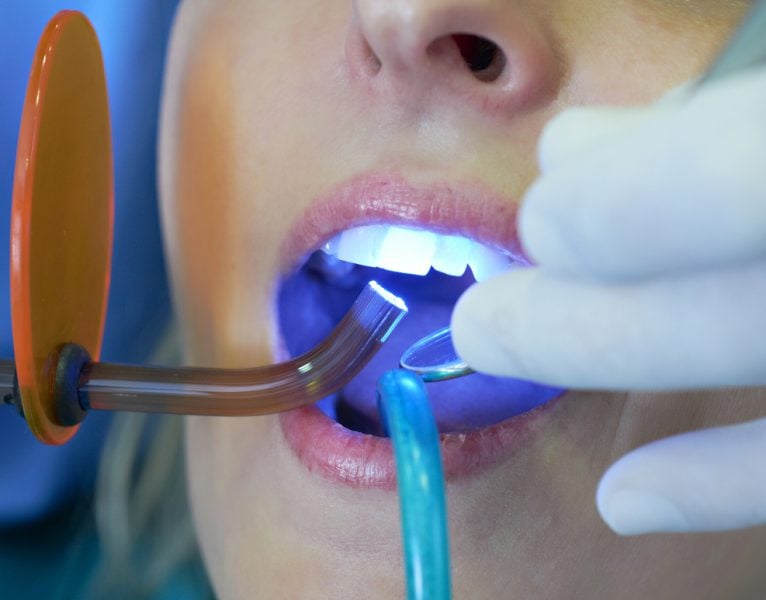 Teeth Whitening with Sarasota Dentistry