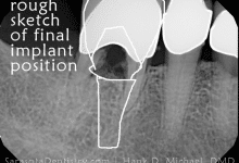 Dental Implant Position x-Ray sketch