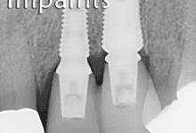 dental implant x-rays from Sarasota Dentistry