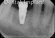 Dental Implant x-Ray Image from Sarasota Dentistry