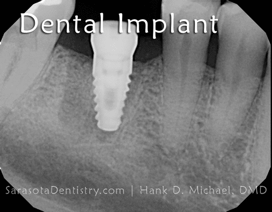 Dental Implant x-Ray Image from Sarasota Dentistry