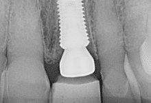temporary dental crown implant x-ray