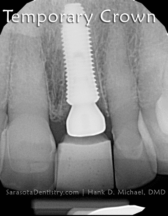 temporary dental crown implant x-ray