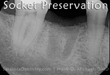 Tooth Socket Preservation X-Ray