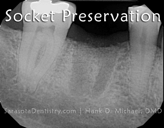 Tooth Socket Preservation X-Ray