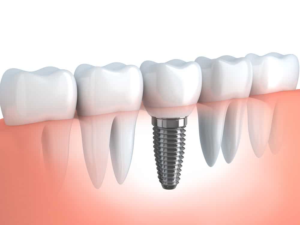 Single Tooth Dental Implant | One Tooth Replacement | Sarasota Dentistry