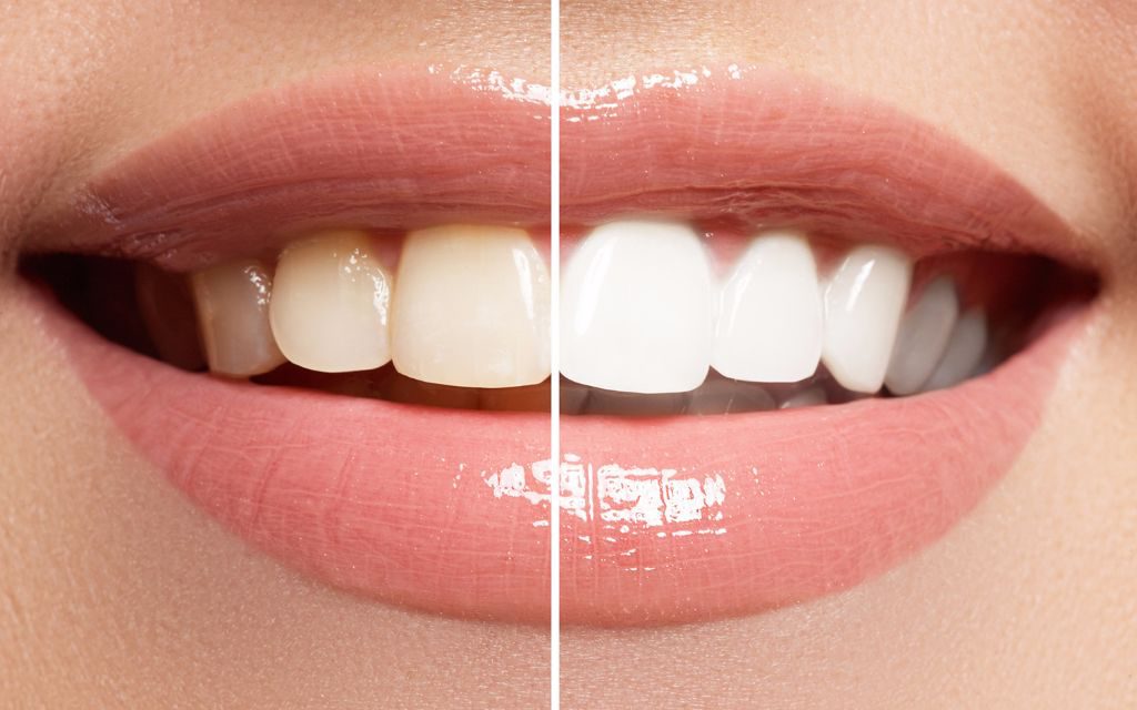 Teeth Whitening at Sarasota Dentistry