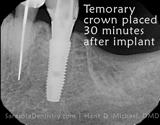 Temporary Crown after dental implant x-ray