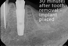 dental implant placement x-ray