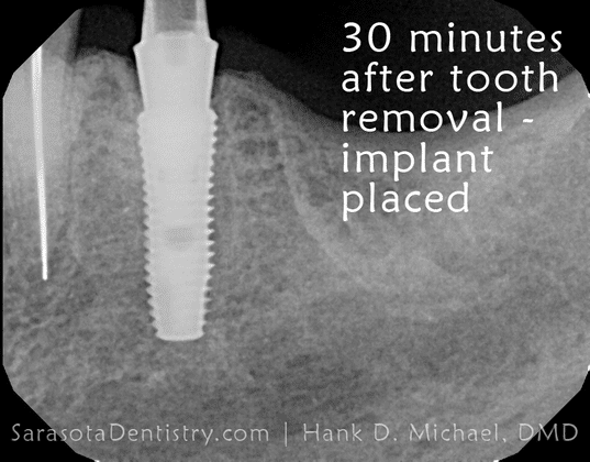 dental implant placement x-ray