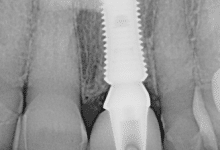 after dental implant heals x-ray