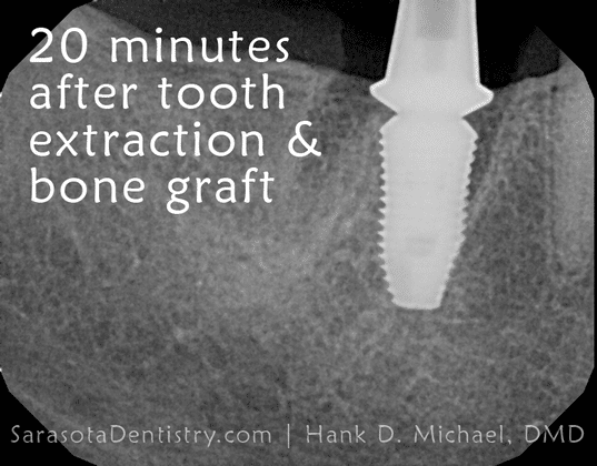 20 minutes after tooth extraction and bone graft