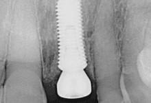 healing dental implant abutement x-ray