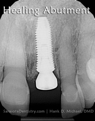 healing dental implant abutement x-ray