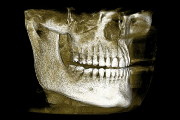 3-D Immediate dental implant CT