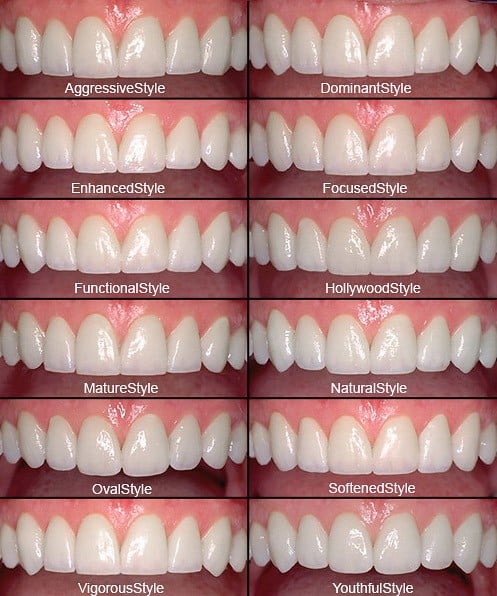 Porcelain Veneer Styles and Shapes Chart