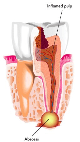 Abscessed Tooth and Inflamed Pulp Dental Emergency