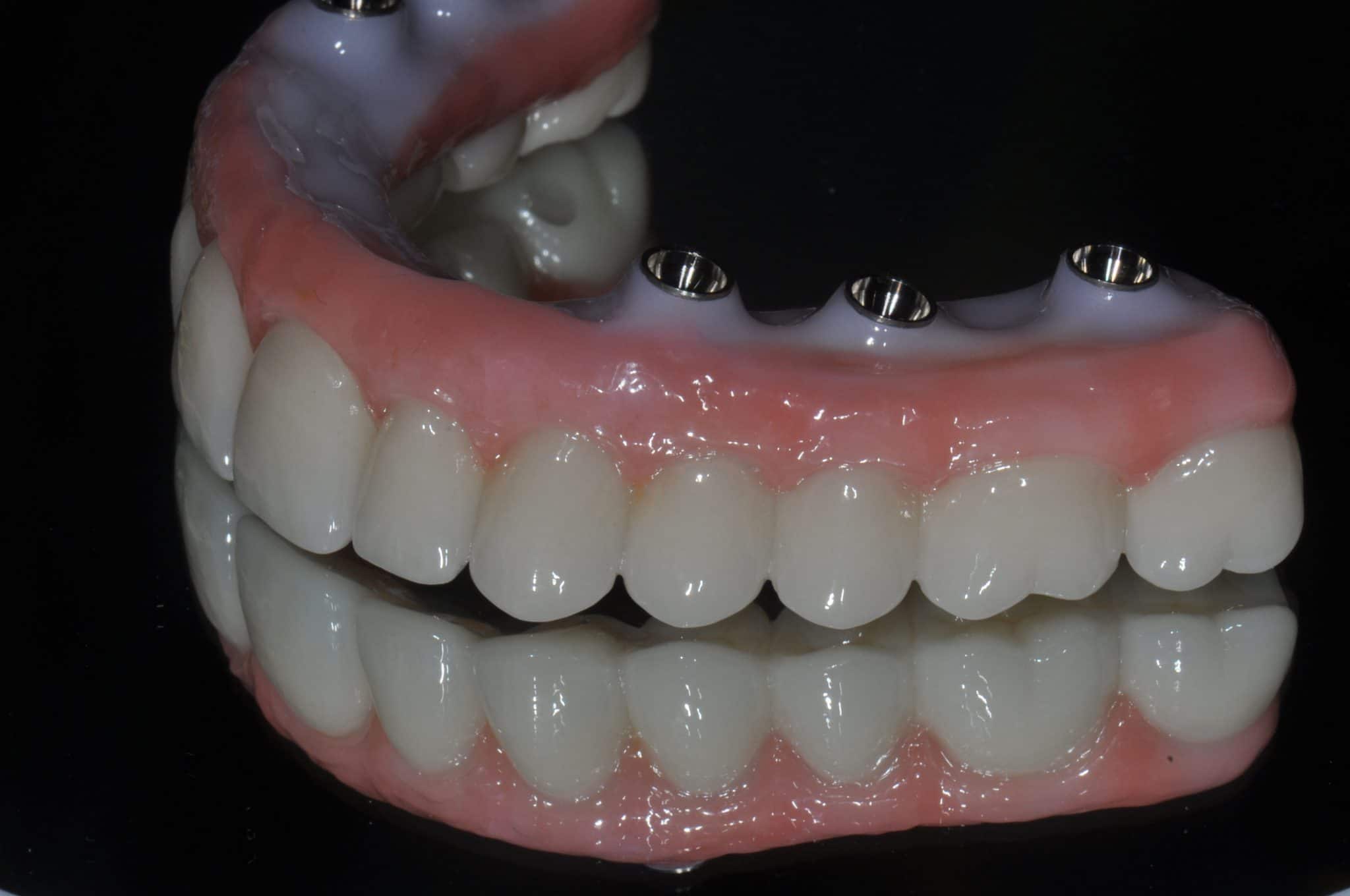 Full Arch Zirconia Prettau Dental Implants