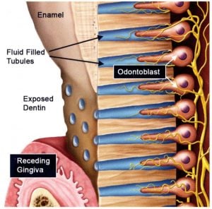 exposed tooth root and dentin tubules