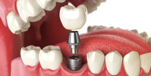 dental implant with screw