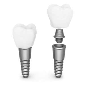 Titanium Dental Implants