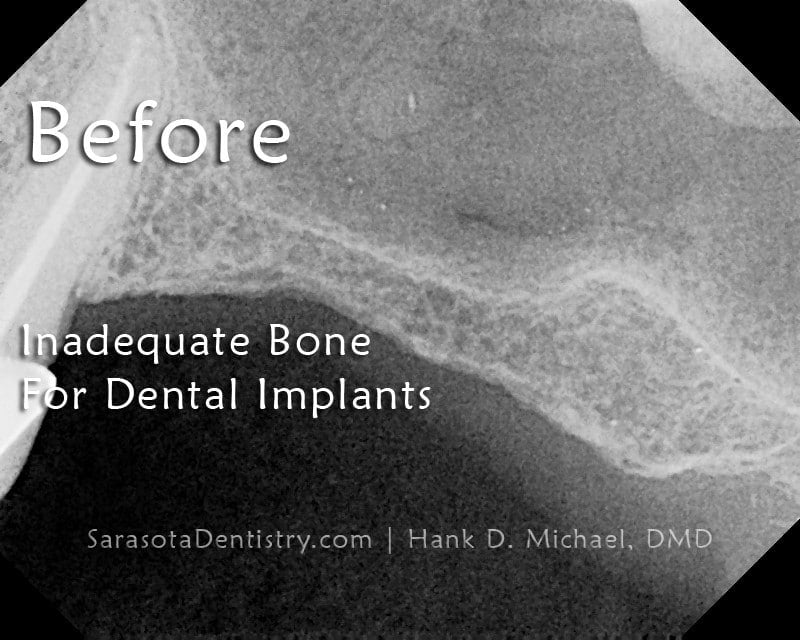 RR1-Before-Bone-Grafting