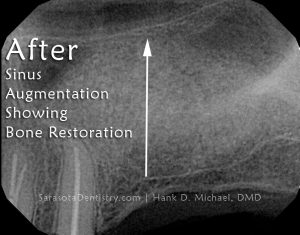 RR2-Sinus-Bone-Graft