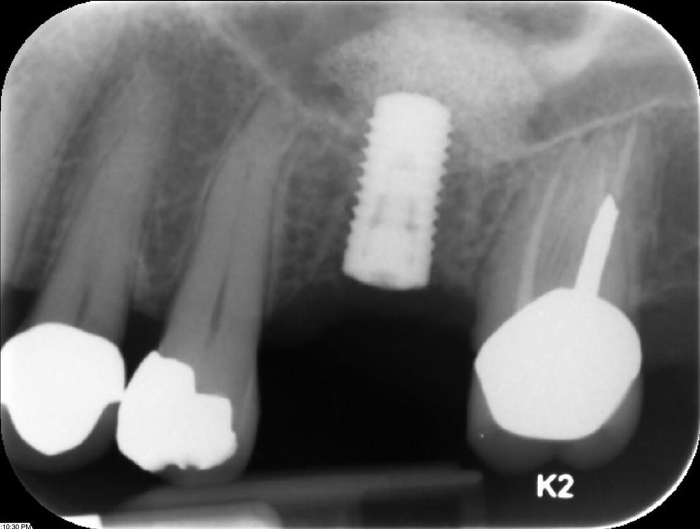 dental implant xray