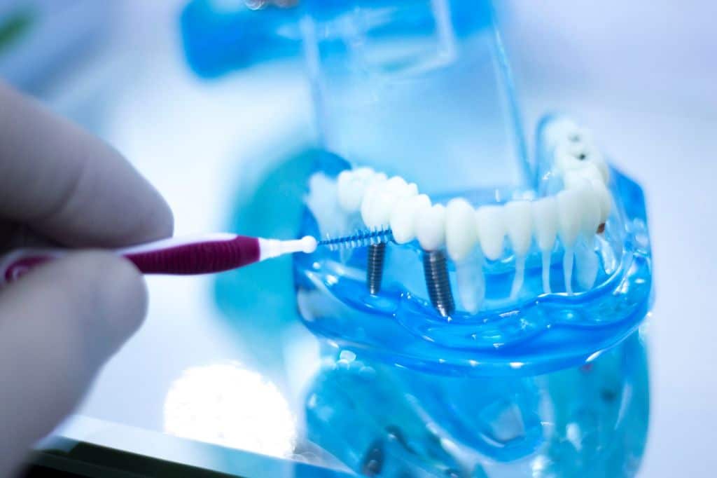 Do You Have to Brush Dental Implants?