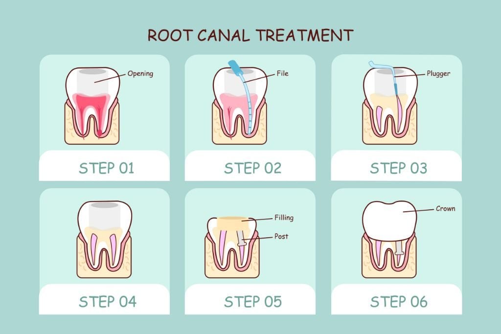 Root canal procedure steps