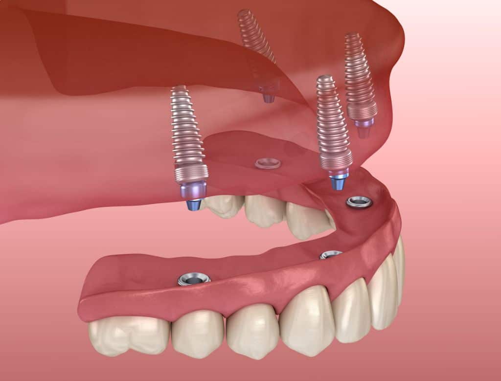 All on 4 Implant Supported Dentures
