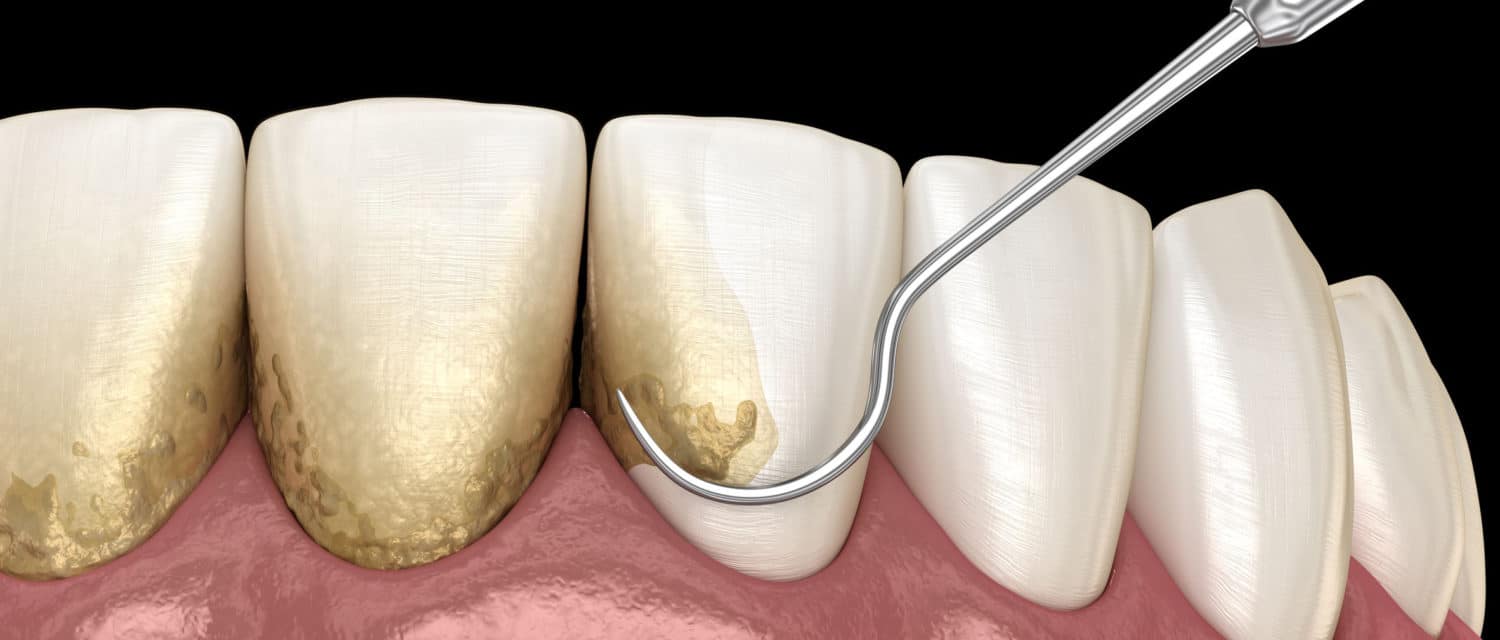 What Is Dental Plaque & How To Remove It