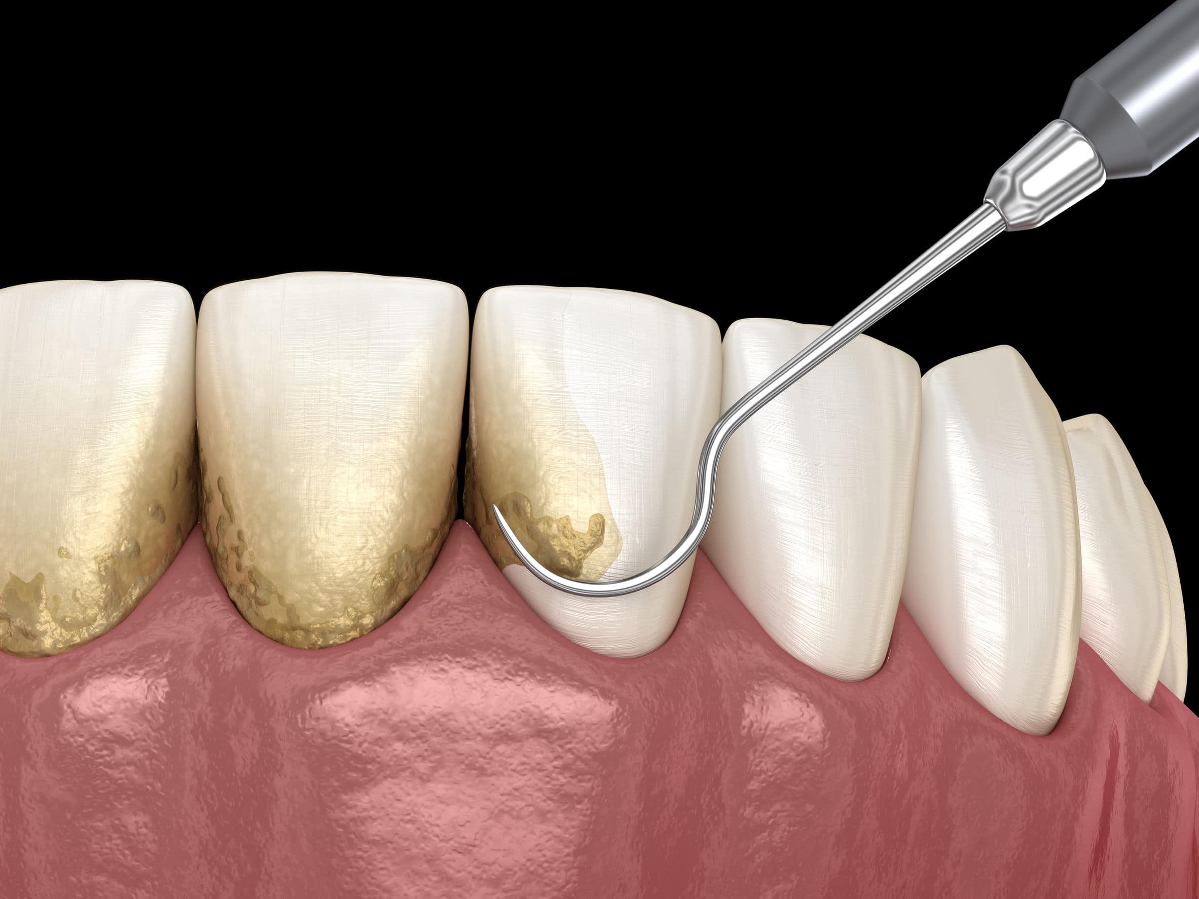 How to remove tartar buildup from teeth on your own without the help of a dentist?