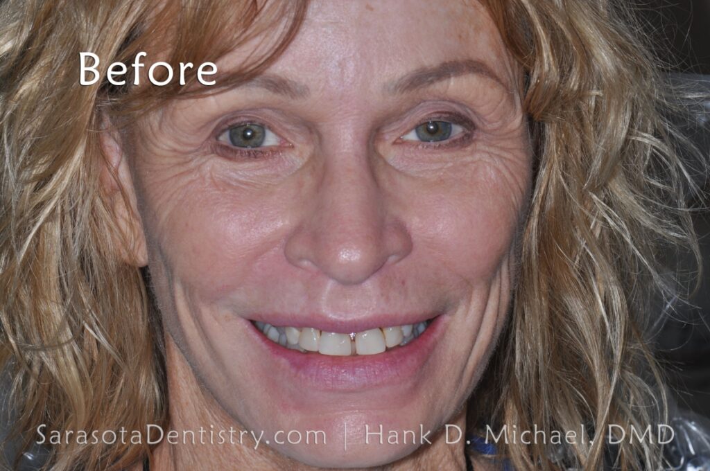 Full Mouth Zirconia Crowns & Implants Makeover 25 Sarasota Dentistry