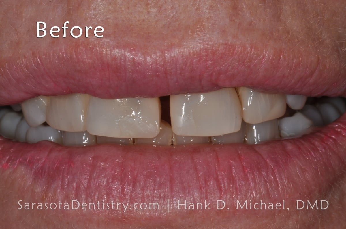 Porcelain Crowns Teeth Before