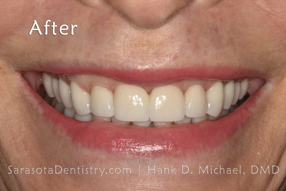 Porcelain Crowns After Smile