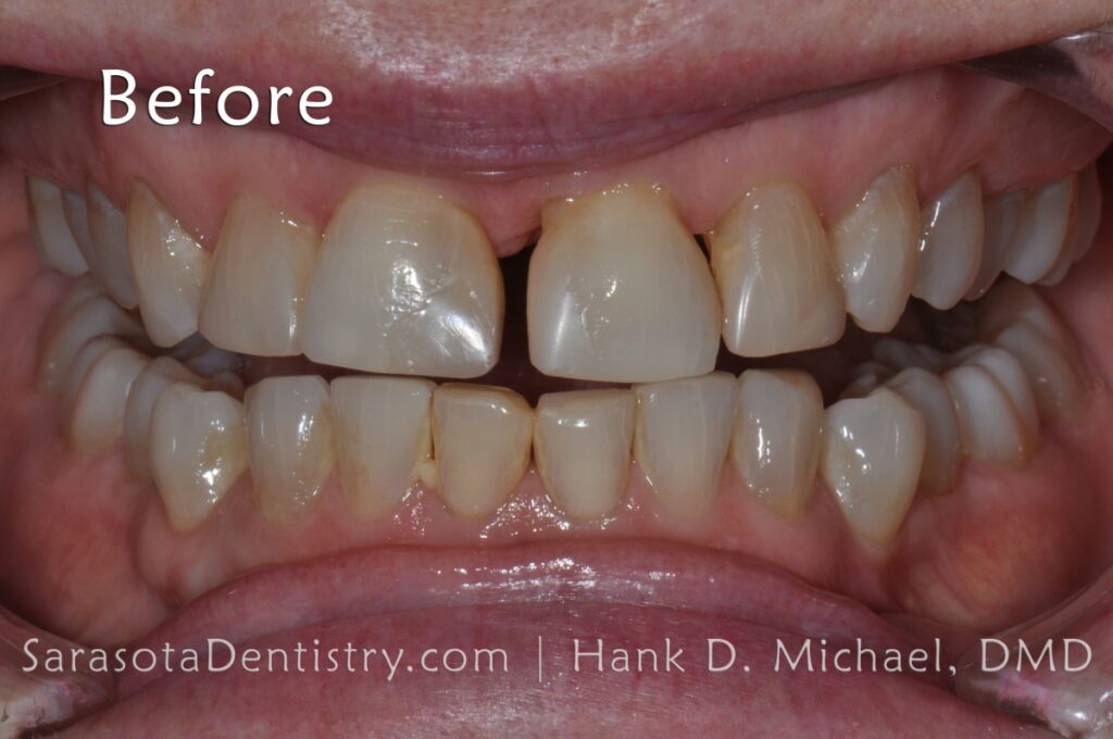 Full Mouth Zirconia Crowns & Implants Makeover 25 Sarasota Dentistry