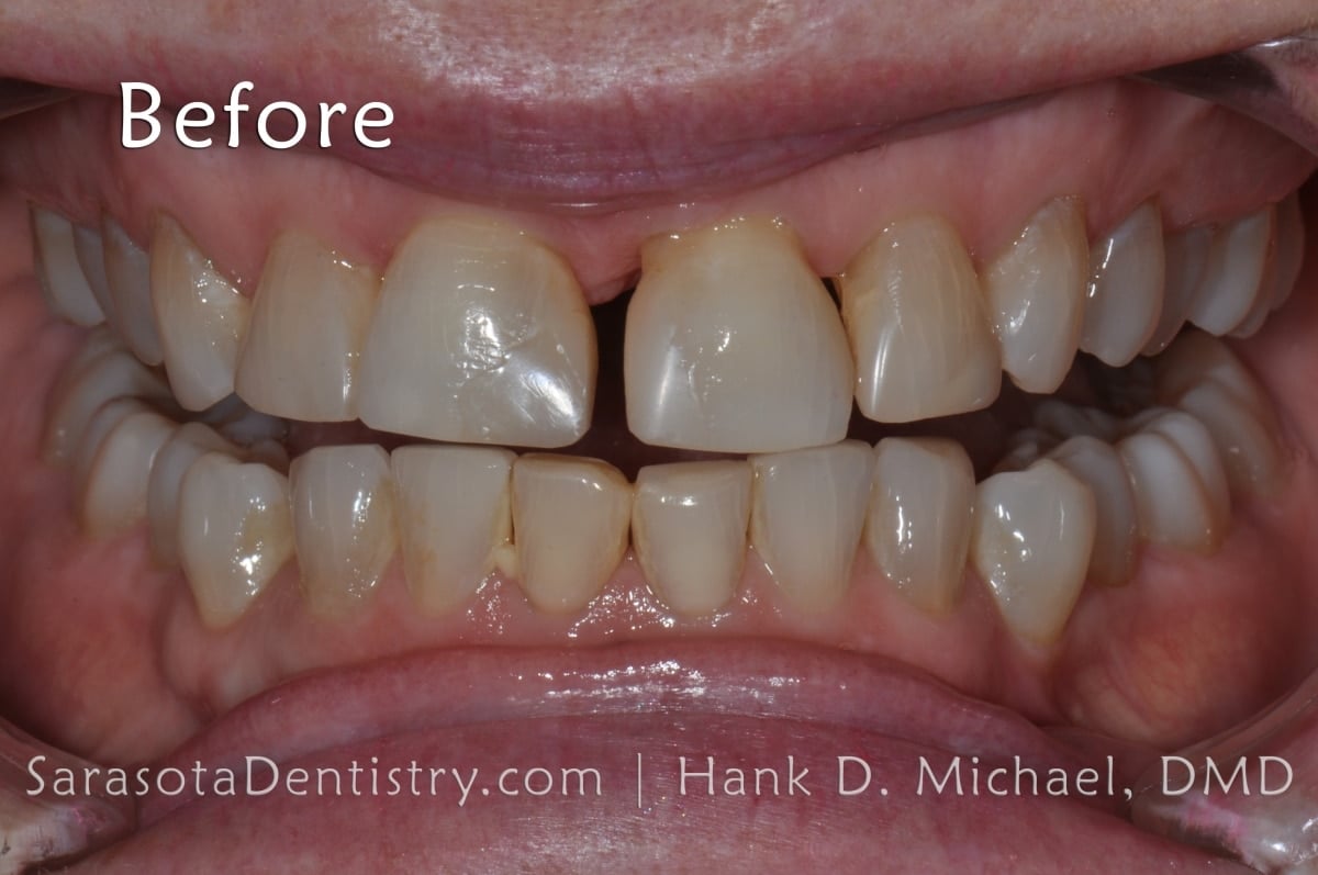 Porcelain Crowns Before Smile Close Up