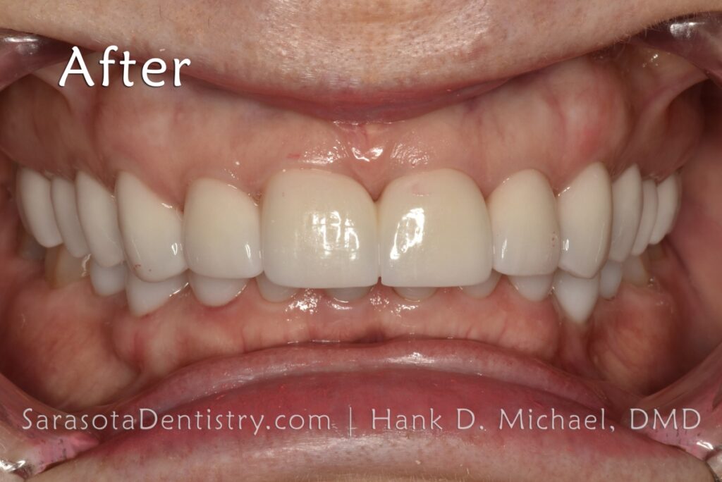 Full Mouth Zirconia Crowns & Implants Makeover 25 Sarasota Dentistry