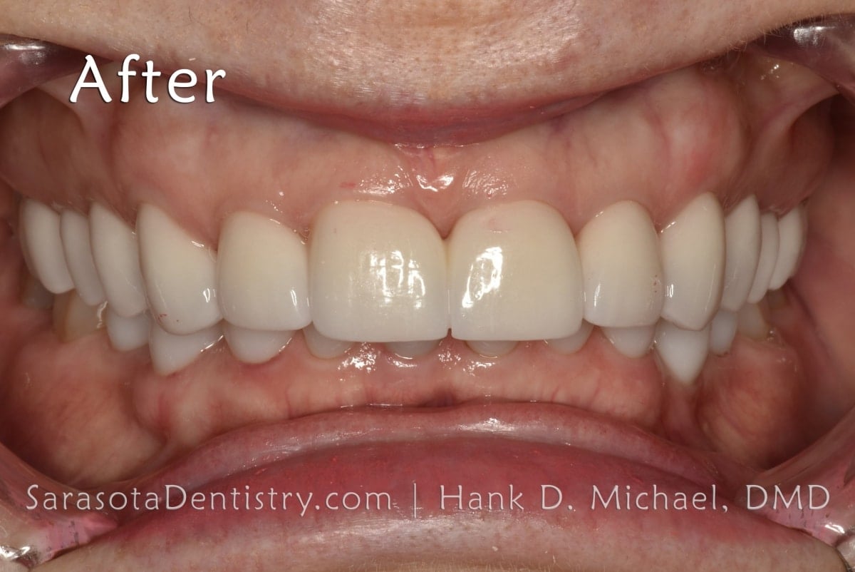 Porcelain Crowns After Smile Close Up